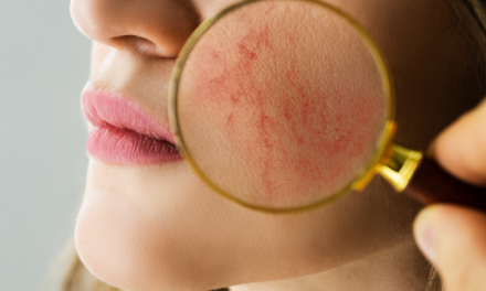 A rosacea elleni harc új dimenziója
