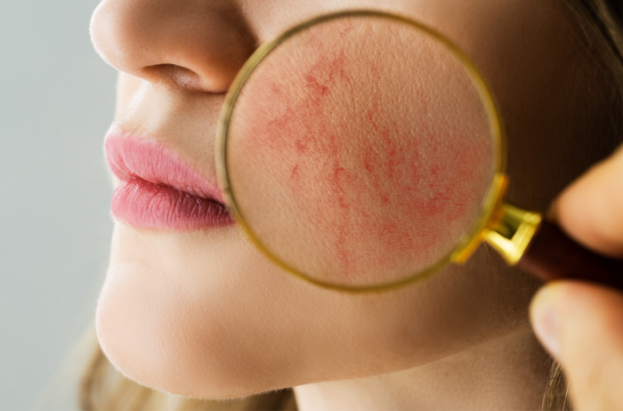 A rosacea elleni harc új dimenziója